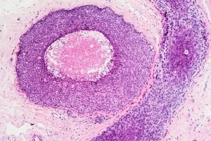 Biomarker Predicts Poor Prognosis in African-Americans with Triple-Negative Breast Cancer