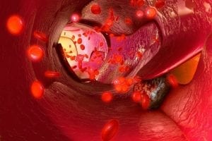Spaser Can Detect, Kill Circulating Tumor Cells to Prevent Cancer Metastases