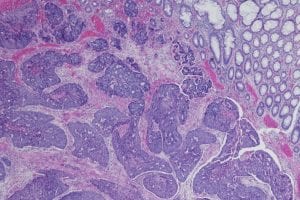 Enzyme Could Protect Against Type Of Colorectal Cancer By Suppressing Tumors, Study Finds