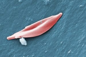 Leveraging Data To Improve The Lives Of Georgians With Sickle Cell