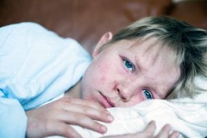 Researchers Identify Key Areas Of Measles Virus Polymerase To Target For Antiviral Drug Development