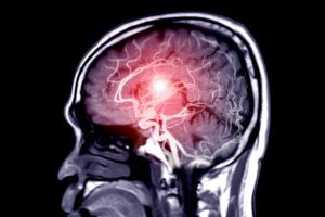 Georgia State Researchers Reveal Surprising Findings on How Salt Affects Blood Flow in the Brain