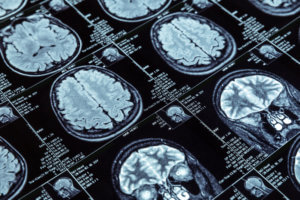 Study: Alzheimer’s Screening Tools May Work Differently for Women and Men